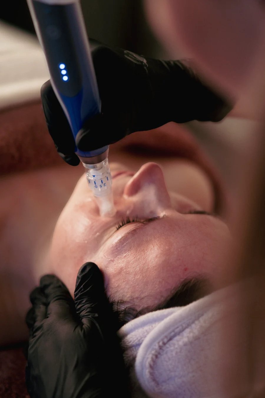 SkinPen microneedling