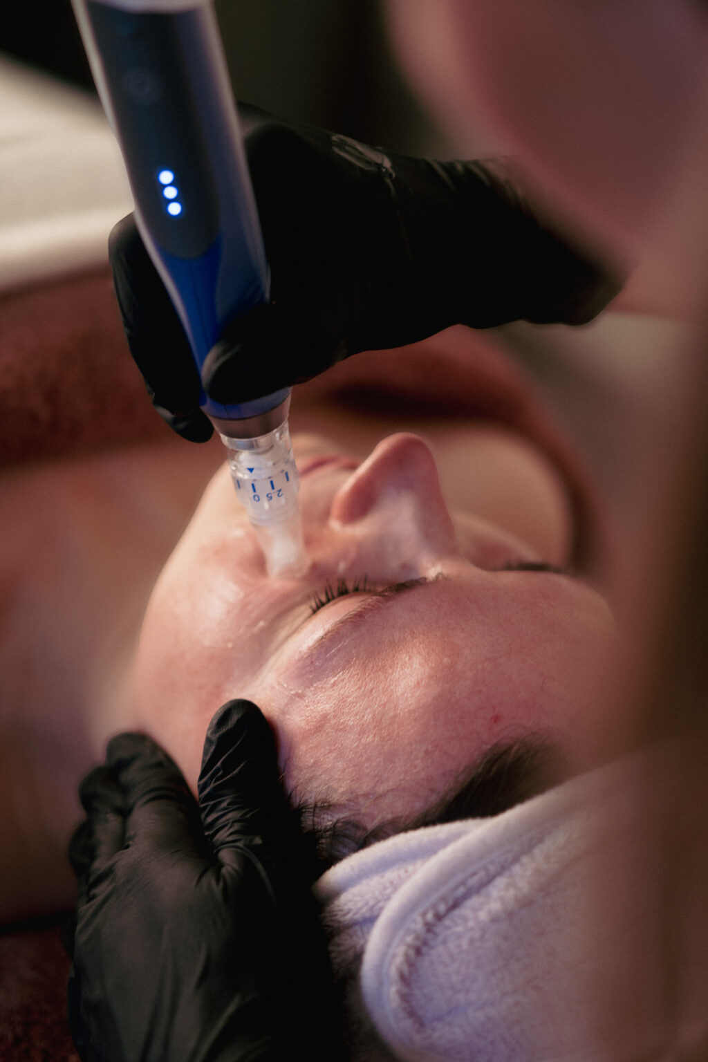 SkinPen microneedling